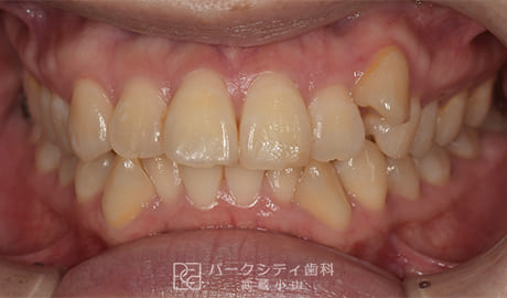 表側矯正による抜歯矯正正面観術前