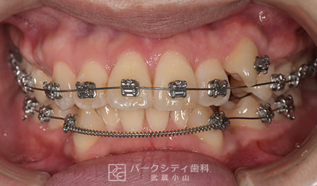 表側矯正による抜歯矯正正面観術中