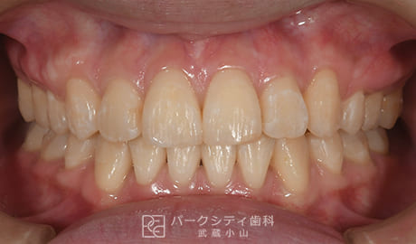 表側矯正による抜歯矯正正面観術後