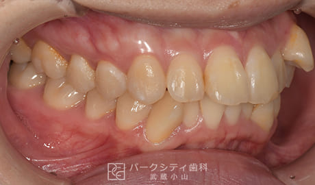表側矯正による抜歯矯正右側面観術前