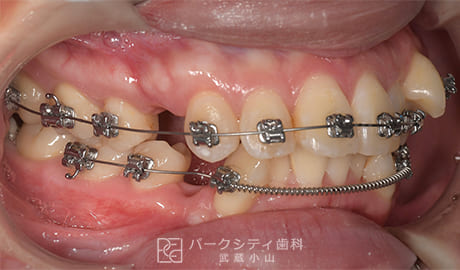 表側矯正による抜歯矯正右側面観術中