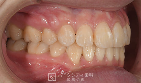 表側矯正による抜歯矯正右側面観術後