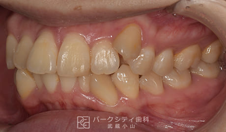 表側矯正による抜歯矯正左側面観術前