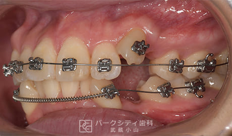 表側矯正による抜歯矯正左側面観術中