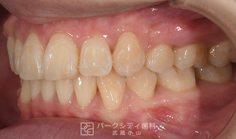 表側矯正による抜歯矯正左側面観術後