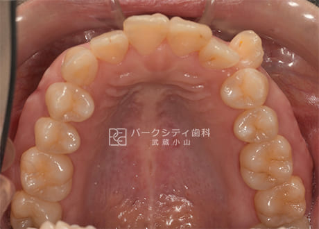 表側矯正による抜歯矯正上顎術前