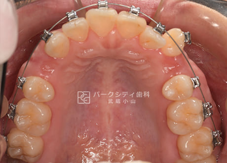 表側矯正による抜歯矯正上顎術直中