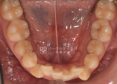 表側矯正による抜歯矯正下顎術前