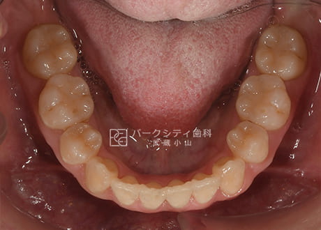表側矯正による抜歯矯正下顎術後