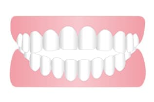 開咬、オープンバイト