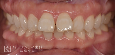 表側の部分矯正の術前