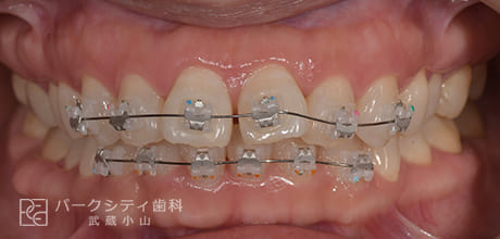 表側の部分矯正の術中1か月