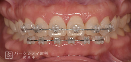 表側の部分矯正の術中3ヶ月