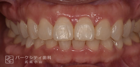 表側の部分矯正の術中4ヶ月