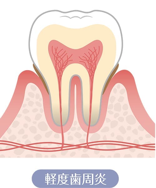 軽度歯周病（歯ぐきが腫れ、押すと血が出る）