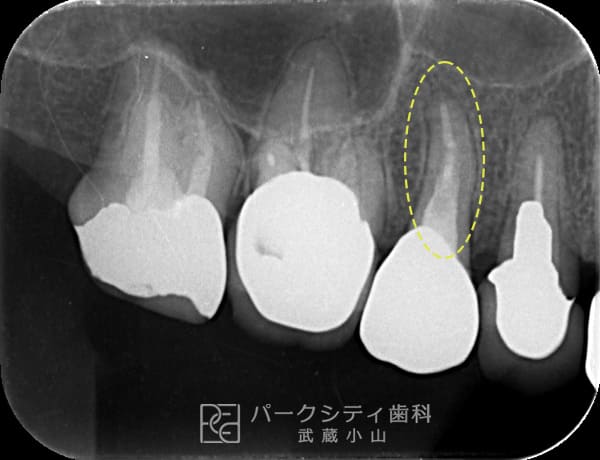 根管治療術前