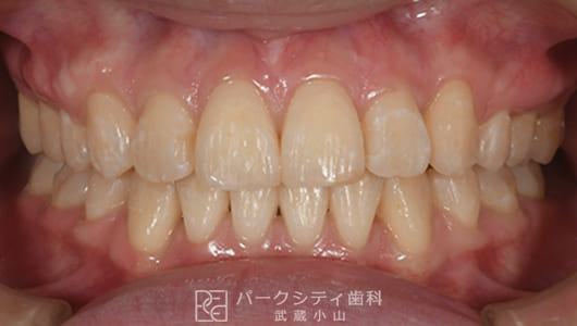 表側矯正による抜歯矯正後