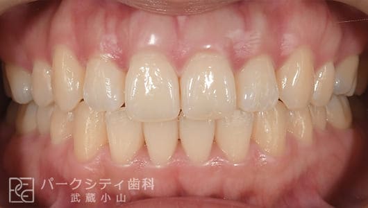 ハーフリンガルでの抜歯矯正後