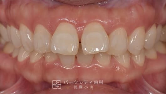 表側の部分矯正前