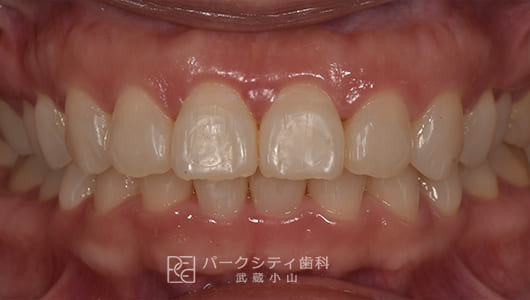 表側の部分矯正後