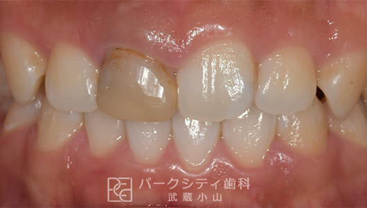 インプラント治療（ルートメンブレンテクニック）前