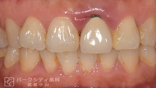 前歯部の抜歯即時インプラント治療前