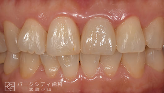 前歯部の抜歯即時インプラント治療後