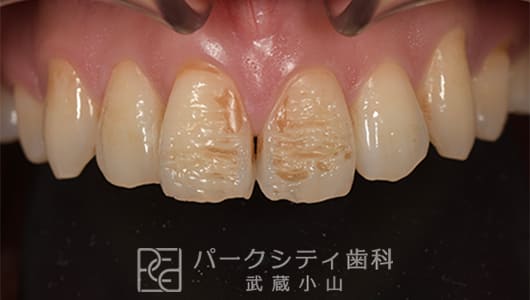 ラミネートベニアで修復前