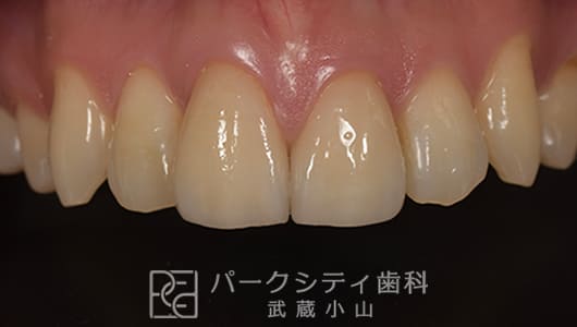 ラミネートベニアで修復後