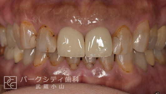 セラミックにて治療（治療期間6か月）前