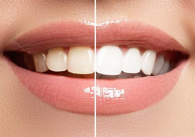 当院のホワイトニングメニュー