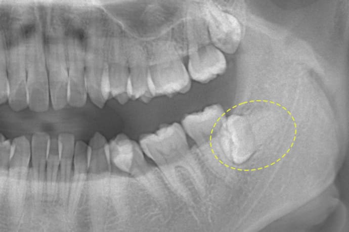 水平埋伏の親知らず